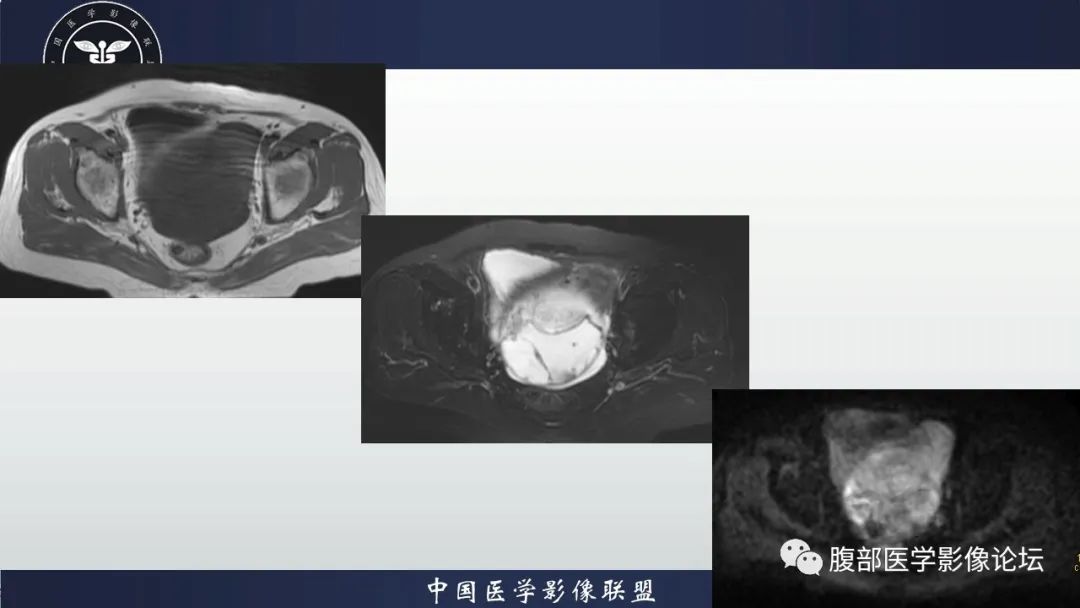影像PPT - 【病例】卵巢甲状腺肿1里MR影像-7
