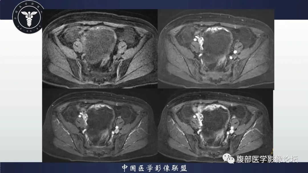 影像PPT - 【病例】卵巢甲状腺肿1里MR影像-8