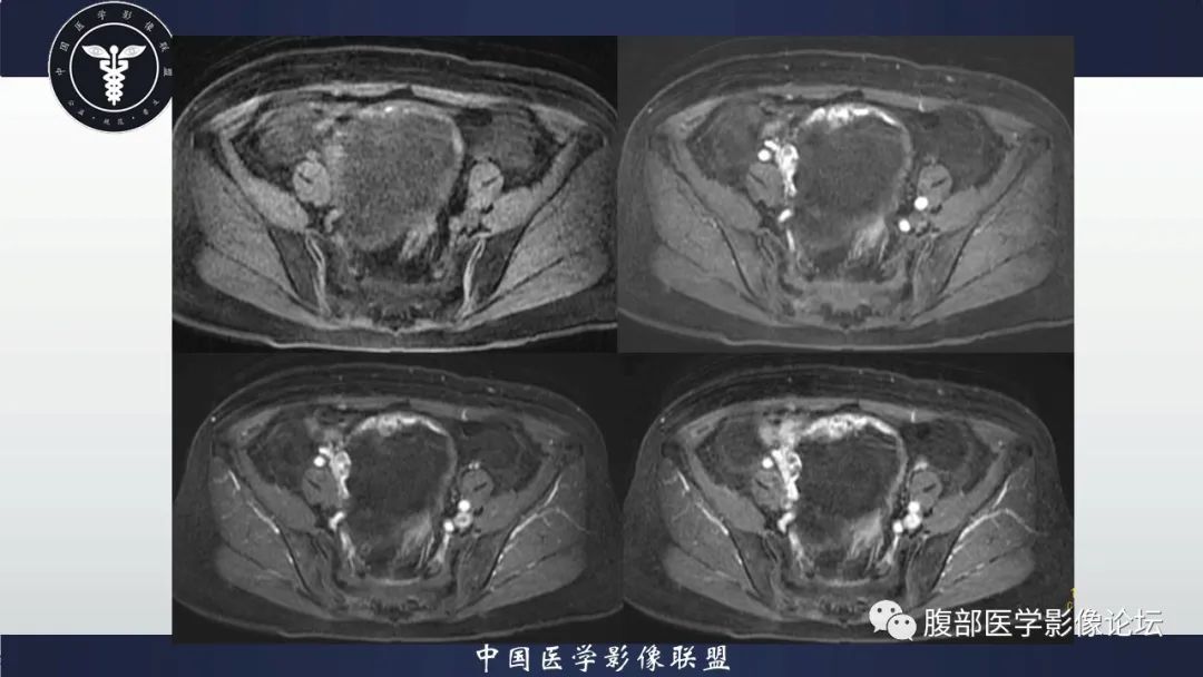 影像PPT - 【病例】卵巢甲状腺肿1里MR影像-9