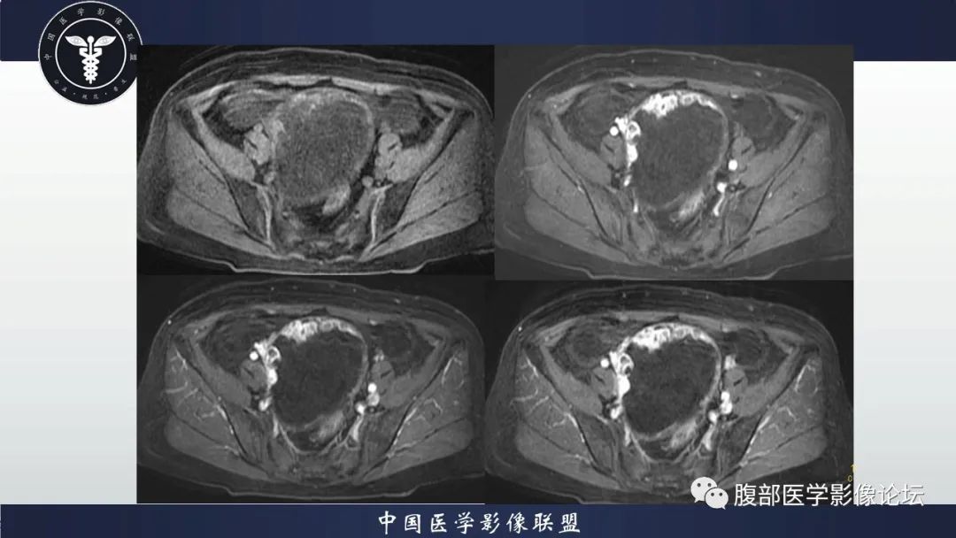 影像PPT - 【病例】卵巢甲状腺肿1里MR影像-10