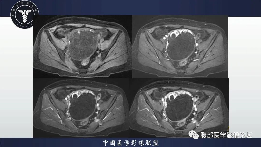 影像PPT - 【病例】卵巢甲状腺肿1里MR影像-11
