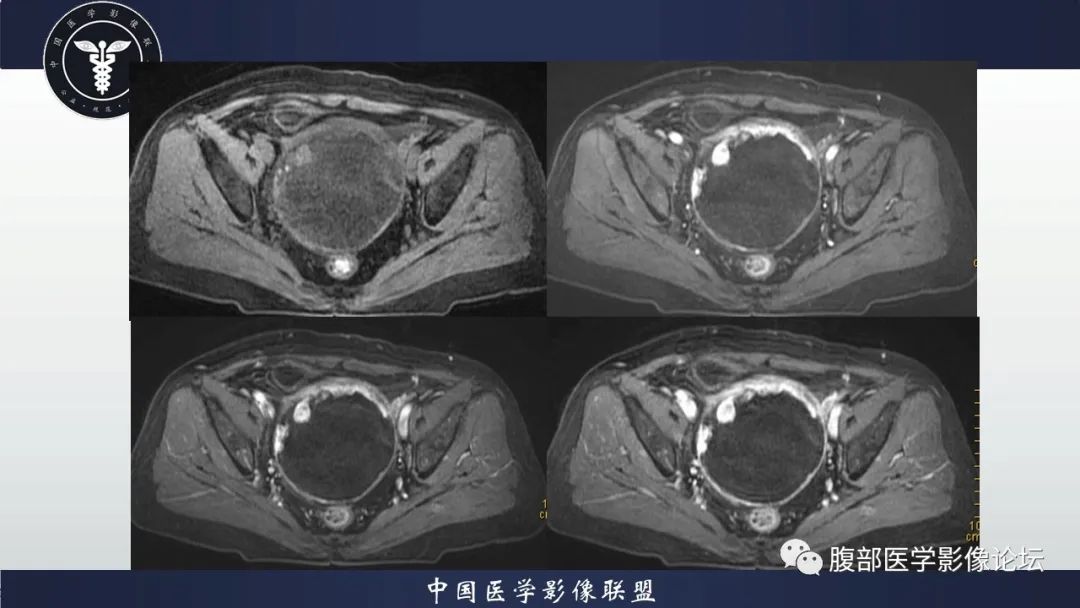影像PPT - 【病例】卵巢甲状腺肿1里MR影像-12
