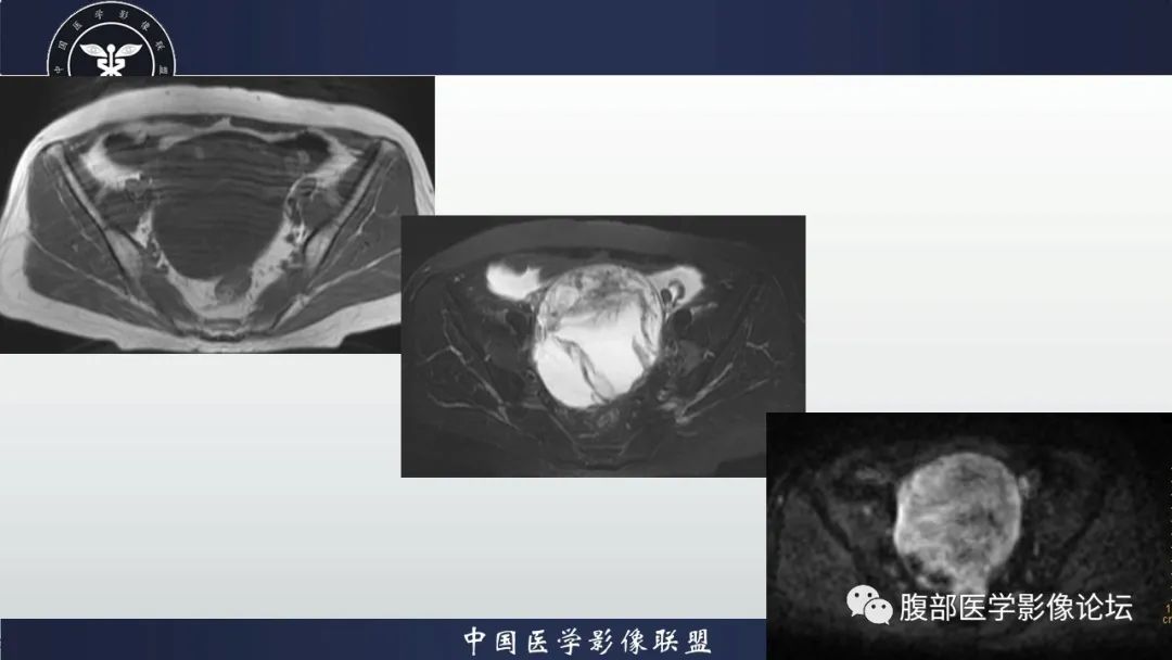 影像PPT - 【病例】卵巢甲状腺肿1里MR影像-5