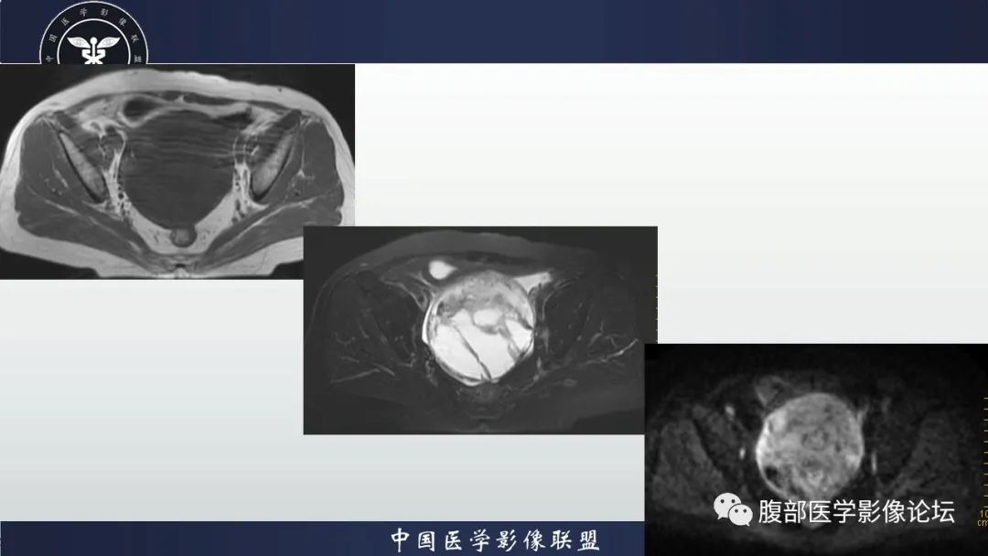 影像PPT - 【病例】卵巢甲状腺肿1里MR影像-6