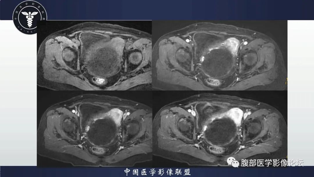 影像PPT - 【病例】卵巢甲状腺肿1里MR影像-13