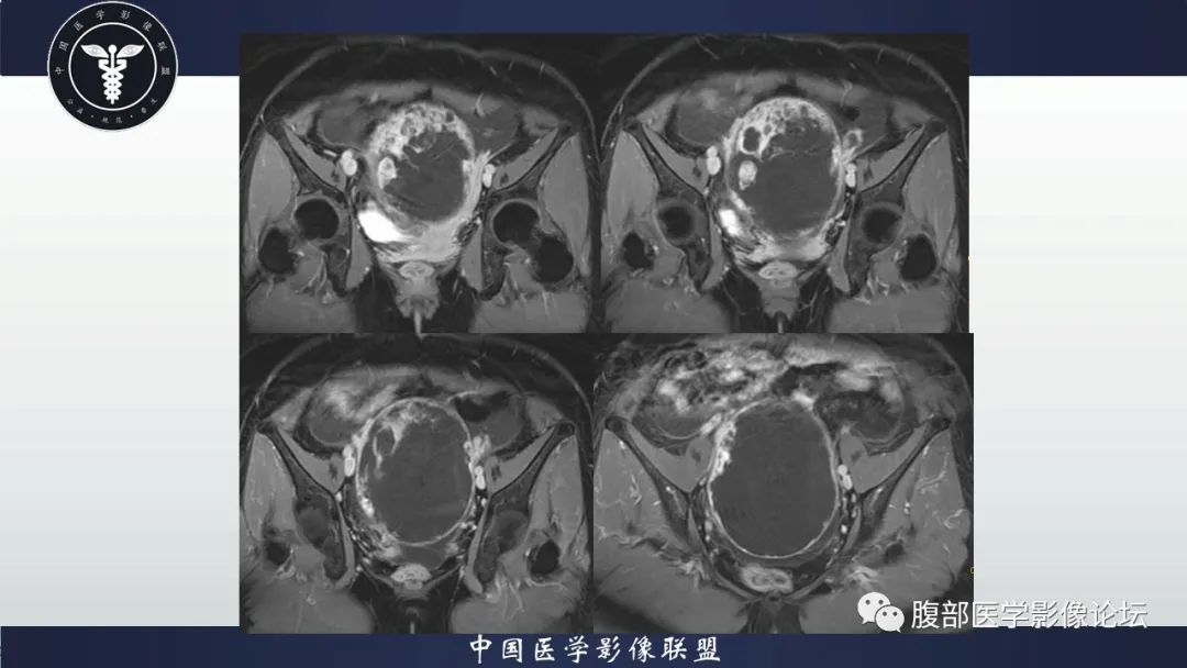 影像PPT - 【病例】卵巢甲状腺肿1里MR影像-15