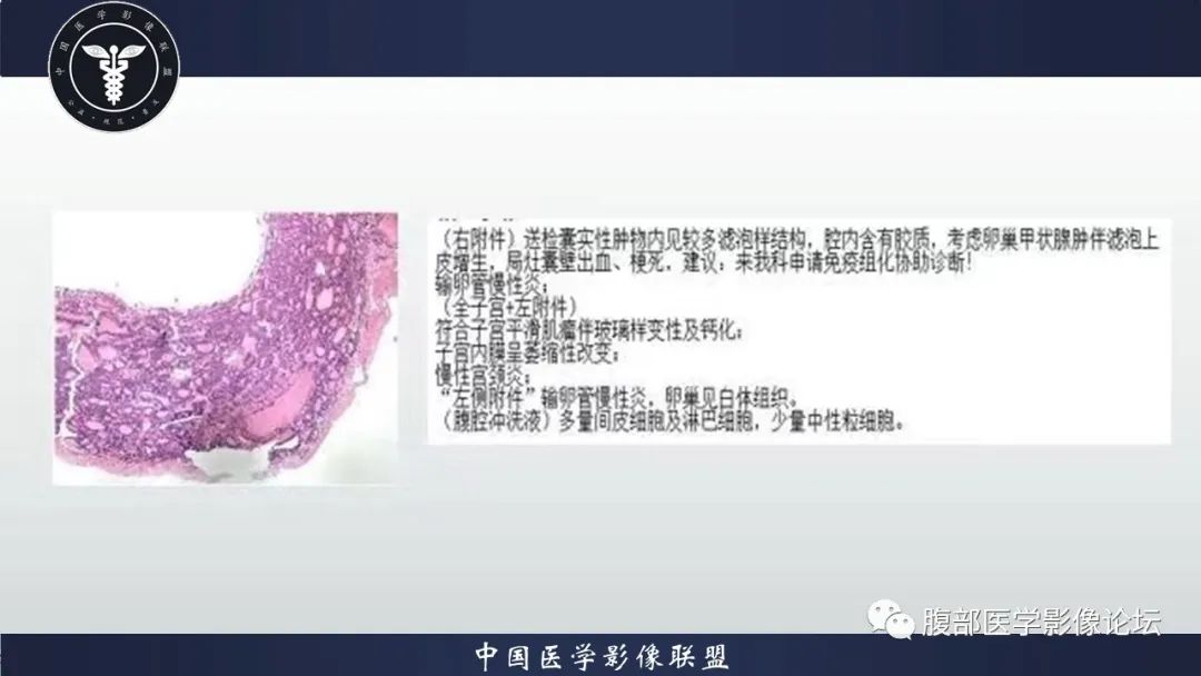 影像PPT - 【病例】卵巢甲状腺肿1里MR影像-16