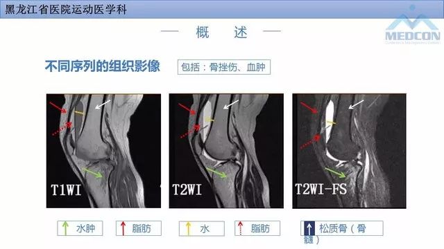影像PPT - 【PPT】膝关节损伤的MR检查-6