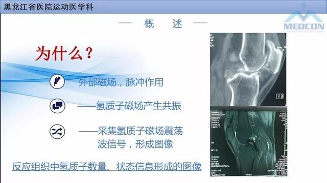 影像PPT - 【PPT】膝关节损伤的MR检查-3