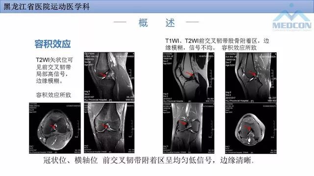 影像PPT - 【PPT】膝关节损伤的MR检查-8