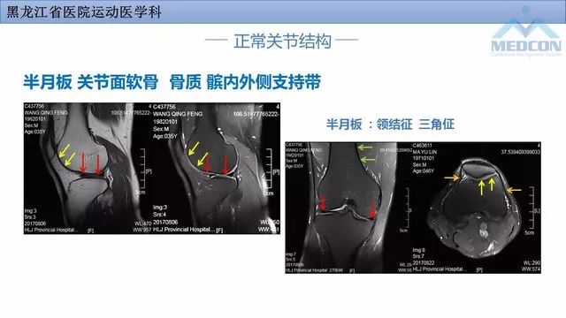 影像PPT - 【PPT】膝关节损伤的MR检查-10