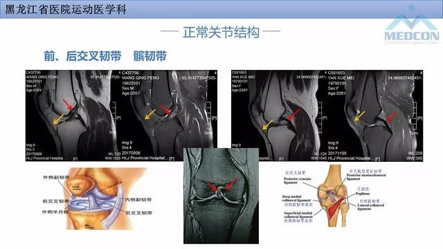 影像PPT - 【PPT】膝关节损伤的MR检查-11