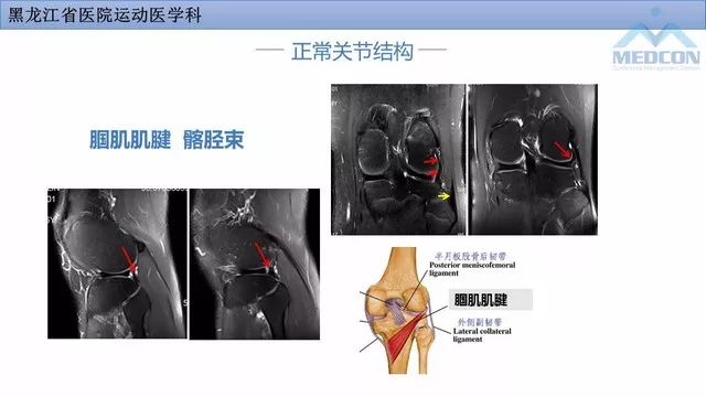 影像PPT - 【PPT】膝关节损伤的MR检查-13