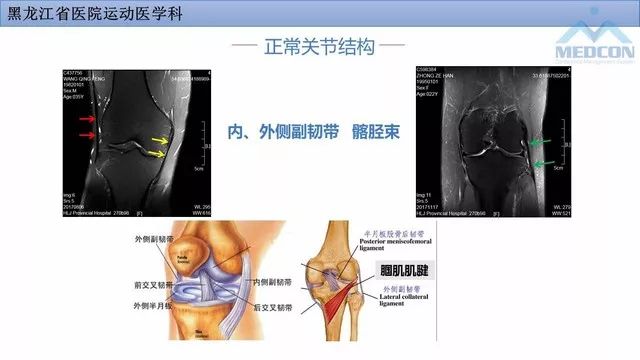影像PPT - 【PPT】膝关节损伤的MR检查-14