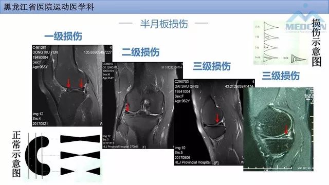 影像PPT - 【PPT】膝关节损伤的MR检查-15
