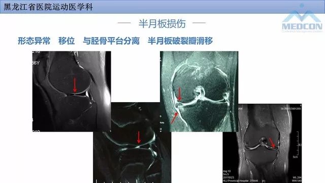 影像PPT - 【PPT】膝关节损伤的MR检查-17