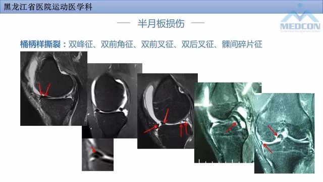 影像PPT - 【PPT】膝关节损伤的MR检查-18