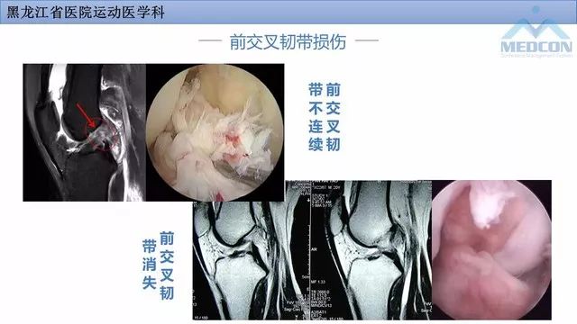 影像PPT - 【PPT】膝关节损伤的MR检查-21
