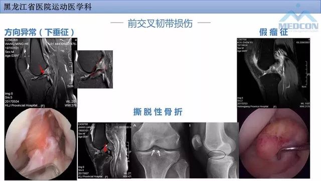 影像PPT - 【PPT】膝关节损伤的MR检查-22