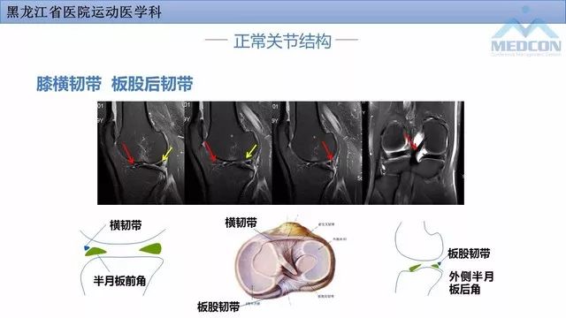 影像PPT - 【PPT】膝关节损伤的MR检查-12