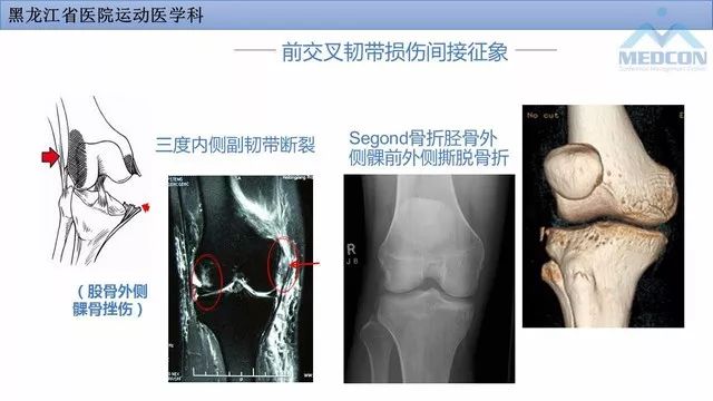 影像PPT - 【PPT】膝关节损伤的MR检查-24