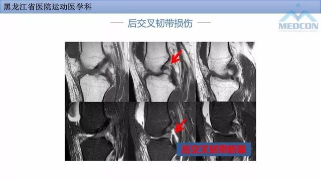 影像PPT - 【PPT】膝关节损伤的MR检查-26