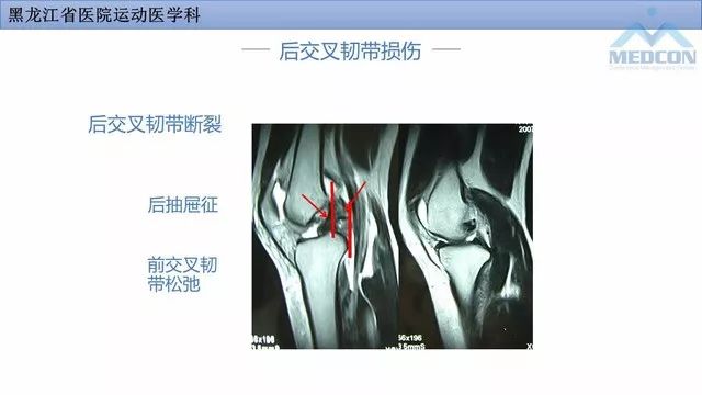 影像PPT - 【PPT】膝关节损伤的MR检查-27