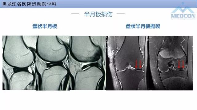 影像PPT - 【PPT】膝关节损伤的MR检查-19