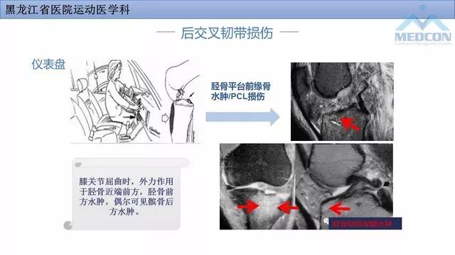 影像PPT - 【PPT】膝关节损伤的MR检查-28