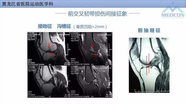 影像PPT - 【PPT】膝关节损伤的MR检查-23