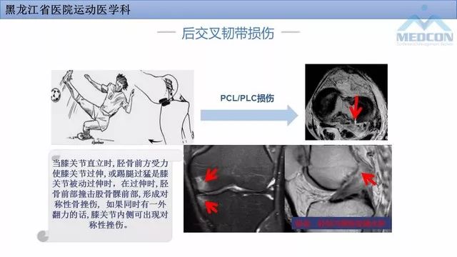 影像PPT - 【PPT】膝关节损伤的MR检查-29