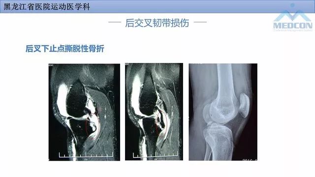 影像PPT - 【PPT】膝关节损伤的MR检查-30