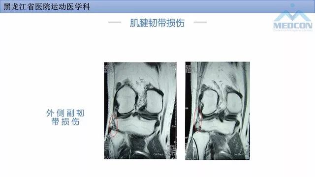影像PPT - 【PPT】膝关节损伤的MR检查-32