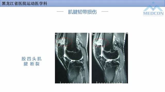 影像PPT - 【PPT】膝关节损伤的MR检查-33
