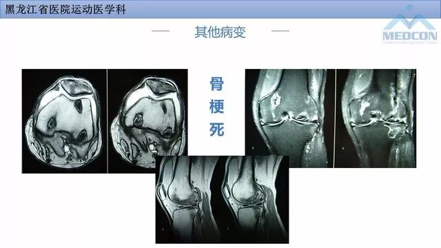影像PPT - 【PPT】膝关节损伤的MR检查-35