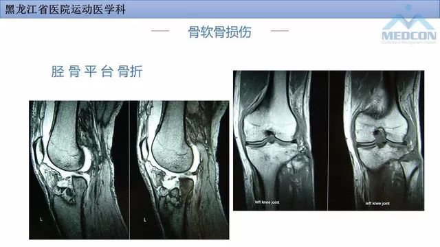 影像PPT - 【PPT】膝关节损伤的MR检查-34
