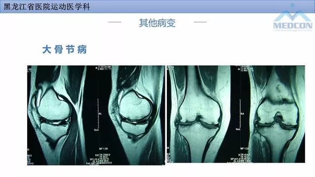影像PPT - 【PPT】膝关节损伤的MR检查-36