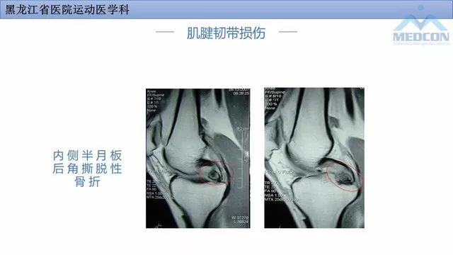 影像PPT - 【PPT】膝关节损伤的MR检查-31