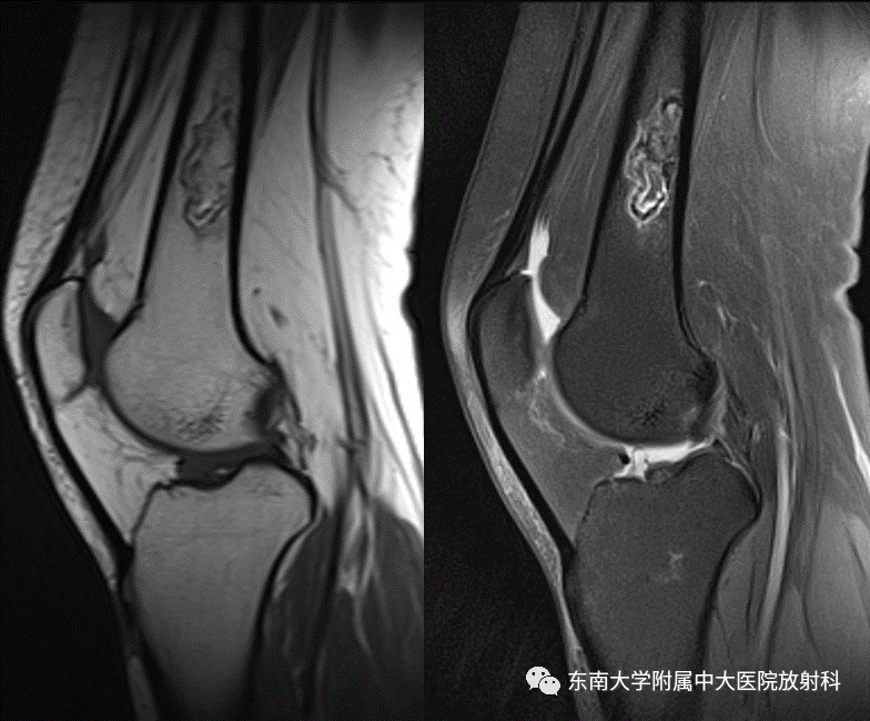影像PPT - 【PPT】骨梗死的影像诊断-2 影像PPT - 【PPT】骨梗死的影像诊断-2