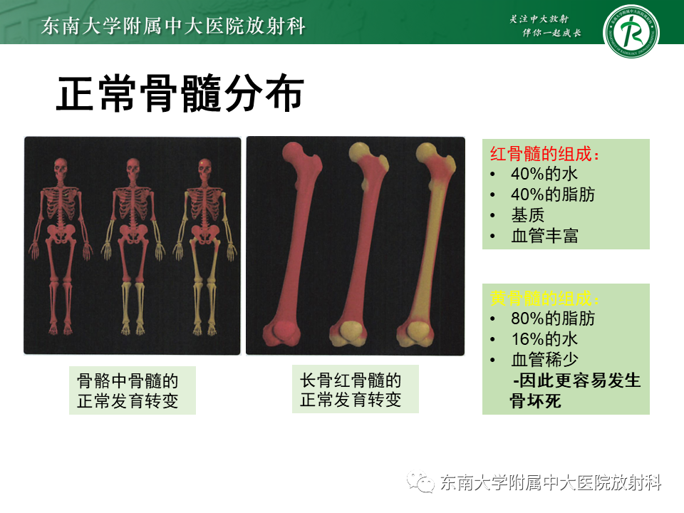 影像PPT - 【PPT】骨梗死的影像诊断-5 影像PPT - 【PPT】骨梗死的影像诊断-5