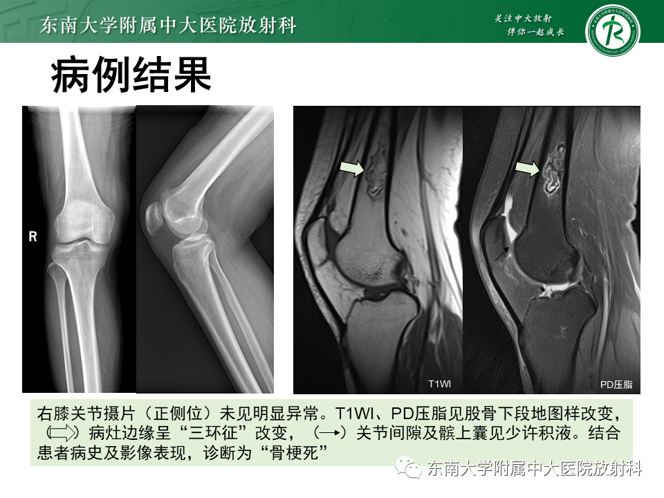 影像PPT - 【PPT】骨梗死的影像诊断-3 影像PPT - 【PPT】骨梗死的影像诊断-3