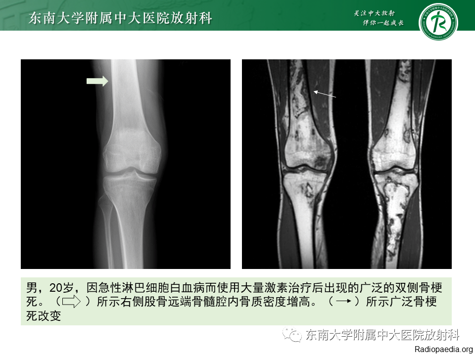 影像PPT - 【PPT】骨梗死的影像诊断-12 影像PPT - 【PPT】骨梗死的影像诊断-12