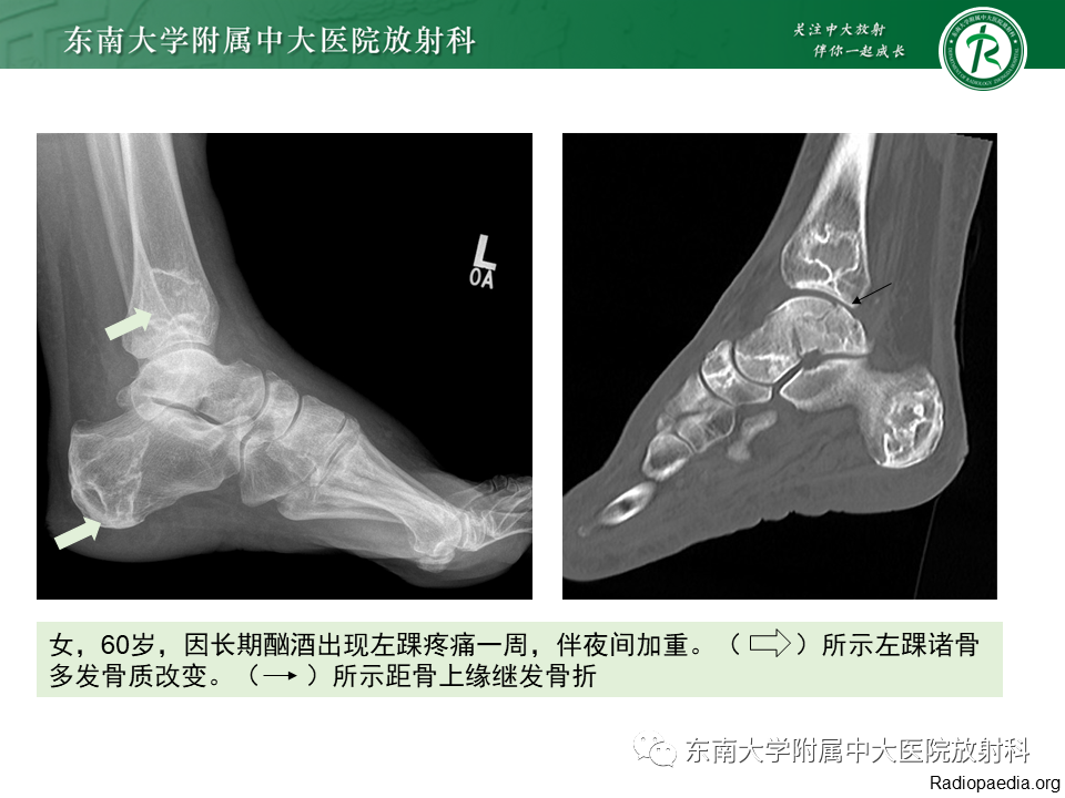 影像PPT - 【PPT】骨梗死的影像诊断-14 影像PPT - 【PPT】骨梗死的影像诊断-14