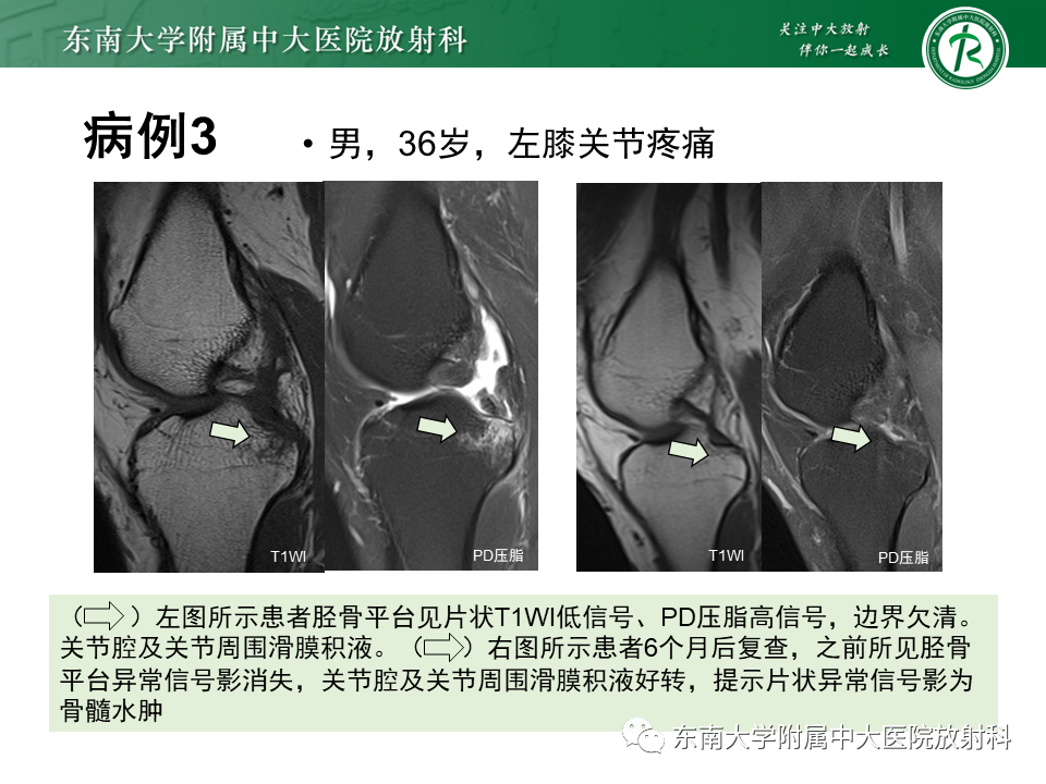 影像PPT - 【PPT】骨梗死的影像诊断-19 影像PPT - 【PPT】骨梗死的影像诊断-19