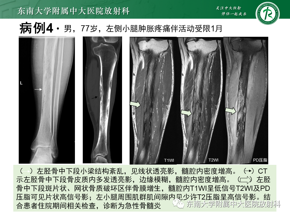 影像PPT - 【PPT】骨梗死的影像诊断-21 影像PPT - 【PPT】骨梗死的影像诊断-21