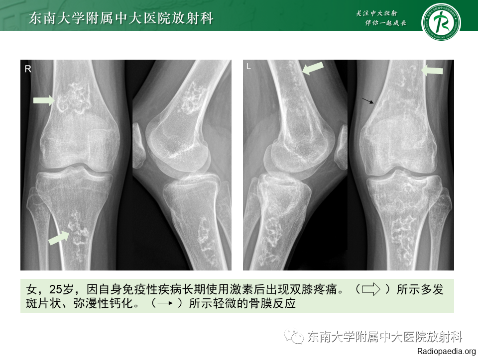 影像PPT - 【PPT】骨梗死的影像诊断-13 影像PPT - 【PPT】骨梗死的影像诊断-13