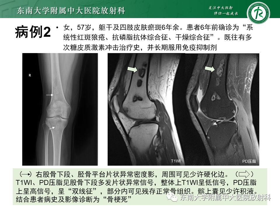 影像PPT - 【PPT】骨梗死的影像诊断-17 影像PPT - 【PPT】骨梗死的影像诊断-17