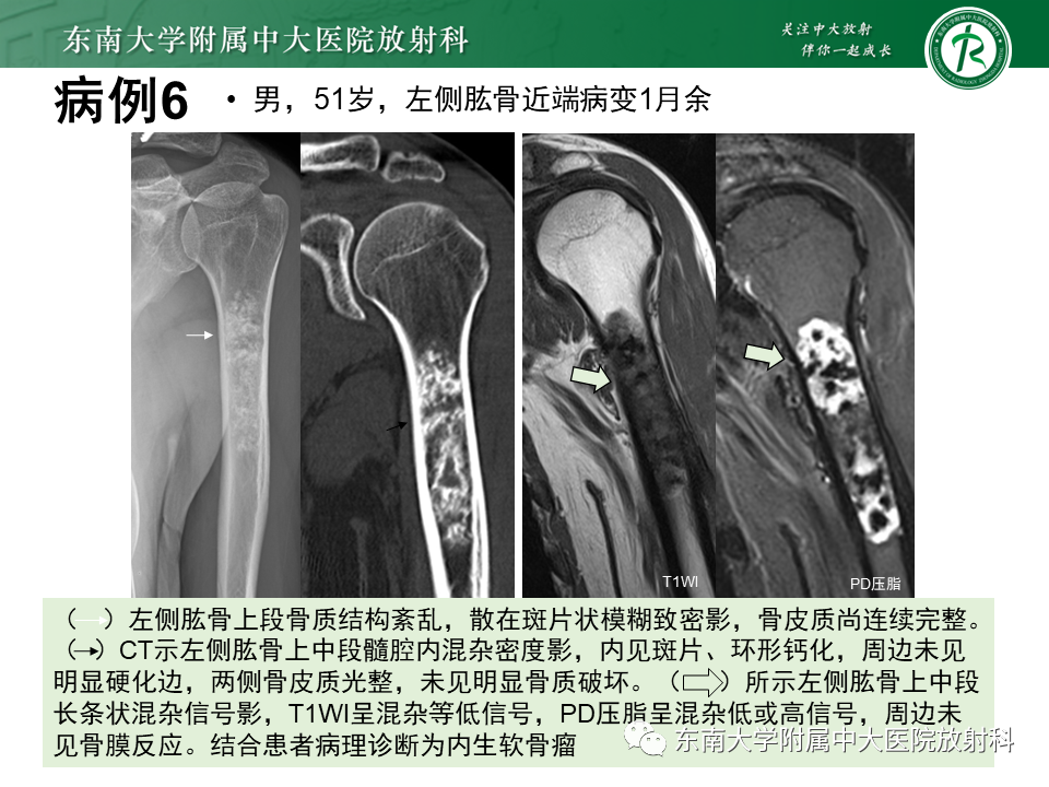 影像PPT - 【PPT】骨梗死的影像诊断-25 影像PPT - 【PPT】骨梗死的影像诊断-25