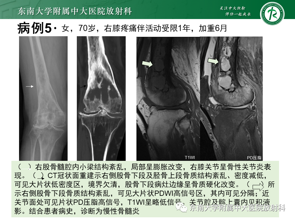 影像PPT - 【PPT】骨梗死的影像诊断-23 影像PPT - 【PPT】骨梗死的影像诊断-23