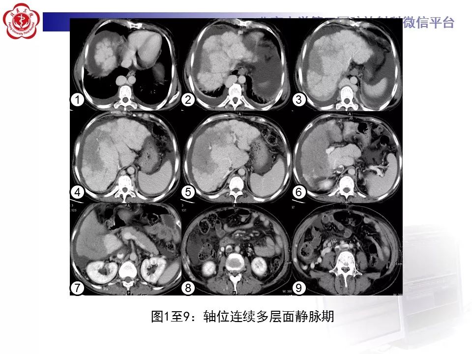 影像PPT - 【PPT】布-加综合征-7